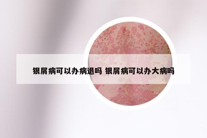银屑病可以办病退吗 银屑病可以办大病吗