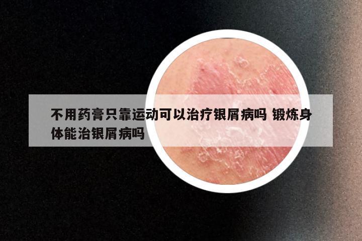 不用药膏只靠运动可以治疗银屑病吗 锻炼身体能治银屑病吗
