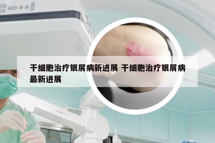 干细胞治疗银屑病新进展 干细胞治疗银屑病最新进展