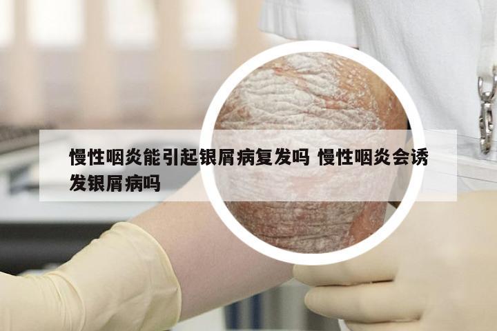 慢性咽炎能引起银屑病复发吗 慢性咽炎会诱发银屑病吗