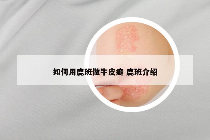 如何用鹿班做牛皮癣 鹿班介绍