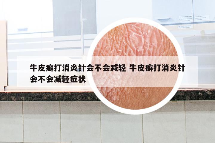 牛皮癣打消炎针会不会减轻 牛皮癣打消炎针会不会减轻症状