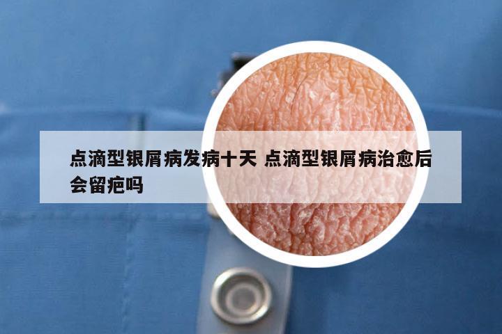 点滴型银屑病发病十天 点滴型银屑病治愈后会留疤吗