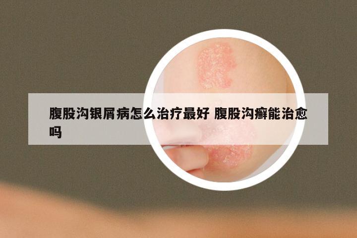 腹股沟银屑病怎么治疗最好 腹股沟癣能治愈吗