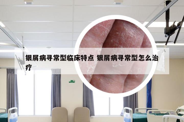 银屑病寻常型临床特点 银屑病寻常型怎么治疗