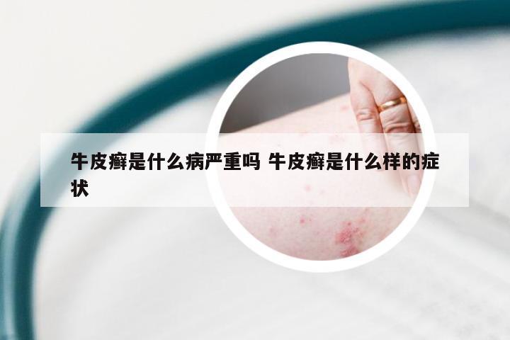 牛皮癣是什么病严重吗 牛皮癣是什么样的症状