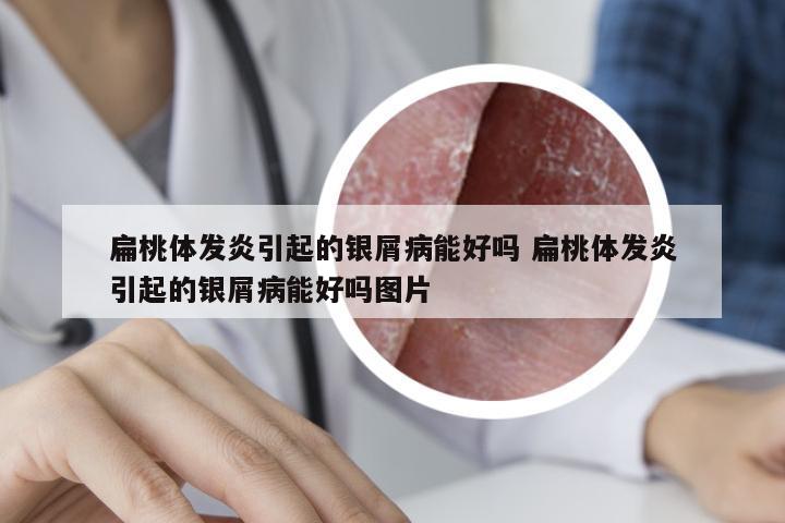 扁桃体发炎引起的银屑病能好吗 扁桃体发炎引起的银屑病能好吗图片