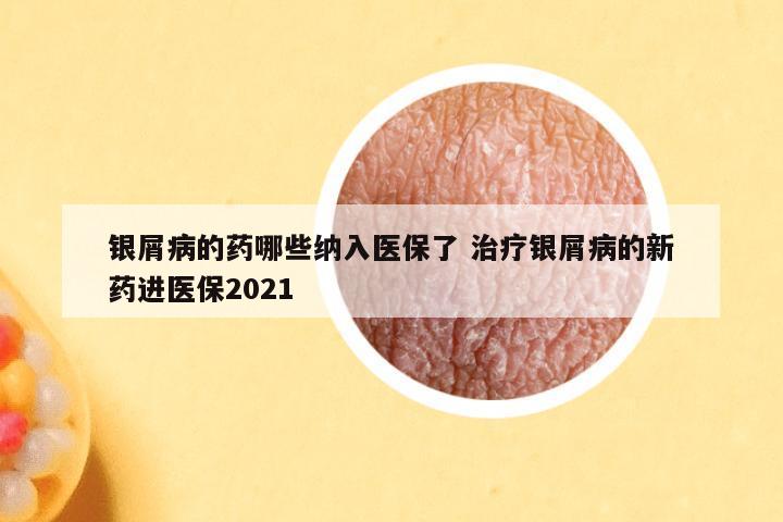 银屑病的药哪些纳入医保了 治疗银屑病的新药进医保2021