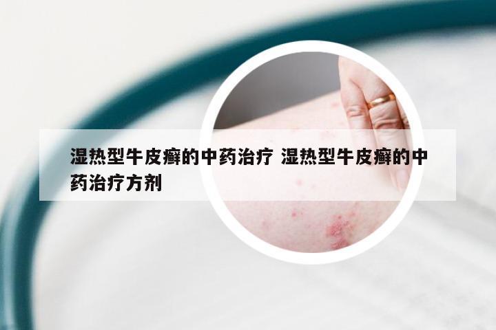 湿热型牛皮癣的中药治疗 湿热型牛皮癣的中药治疗方剂