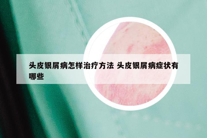 头皮银屑病怎样治疗方法 头皮银屑病症状有哪些
