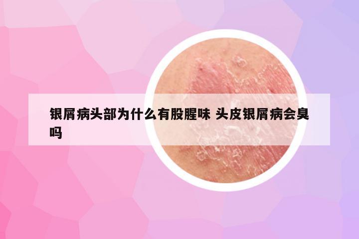 银屑病头部为什么有股腥味 头皮银屑病会臭吗