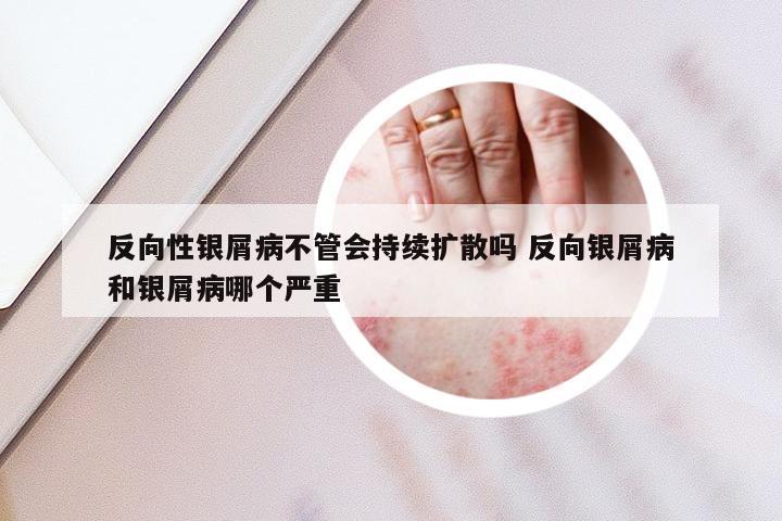 反向性银屑病不管会持续扩散吗 反向银屑病和银屑病哪个严重