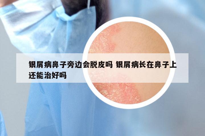 银屑病鼻子旁边会脱皮吗 银屑病长在鼻子上还能治好吗