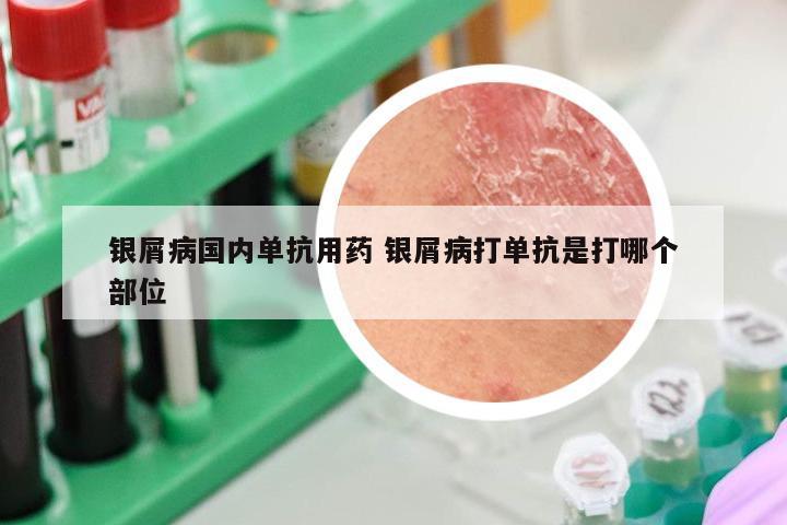 银屑病国内单抗用药 银屑病打单抗是打哪个部位