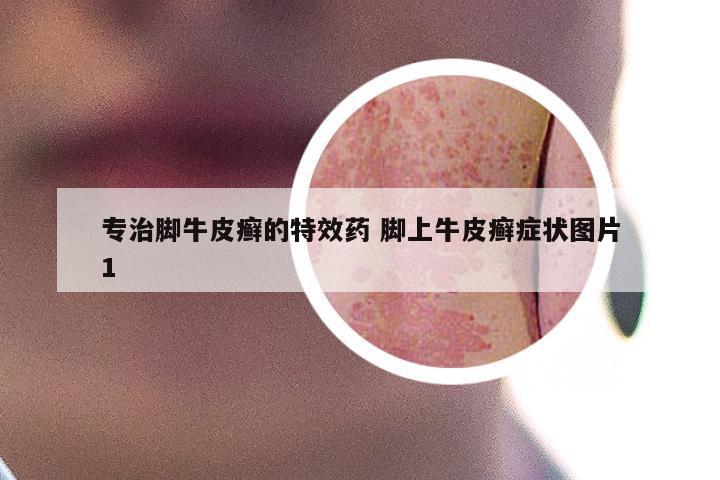 专治脚牛皮癣的特效药 脚上牛皮癣症状图片1