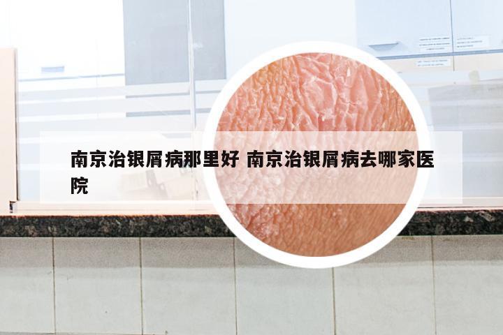 南京治银屑病那里好 南京治银屑病去哪家医院