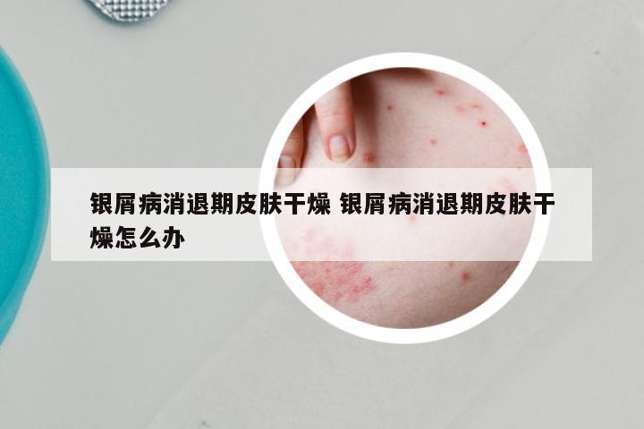 银屑病消退期皮肤干燥 银屑病消退期皮肤干燥怎么办
