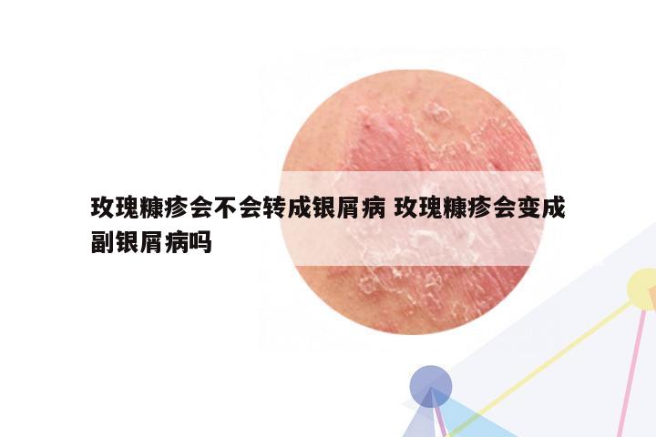 玫瑰糠疹会不会转成银屑病 玫瑰糠疹会变成副银屑病吗