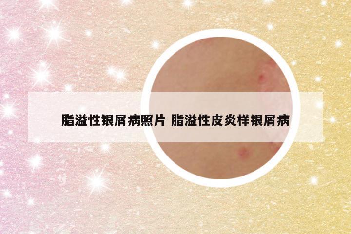脂溢性银屑病照片 脂溢性皮炎样银屑病