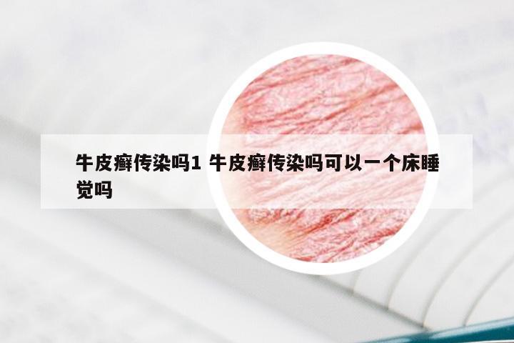 牛皮癣传染吗1 牛皮癣传染吗可以一个床睡觉吗