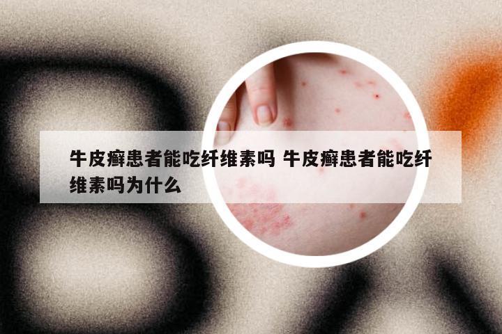 牛皮癣患者能吃纤维素吗 牛皮癣患者能吃纤维素吗为什么