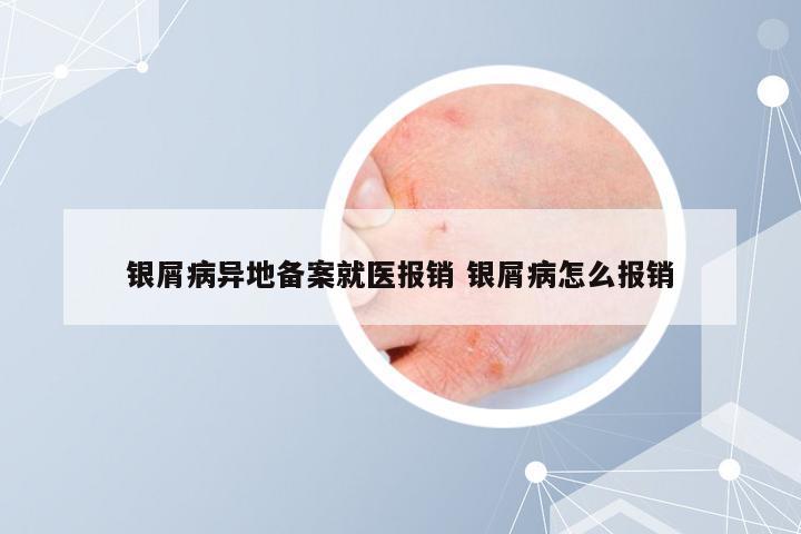 银屑病异地备案就医报销 银屑病怎么报销