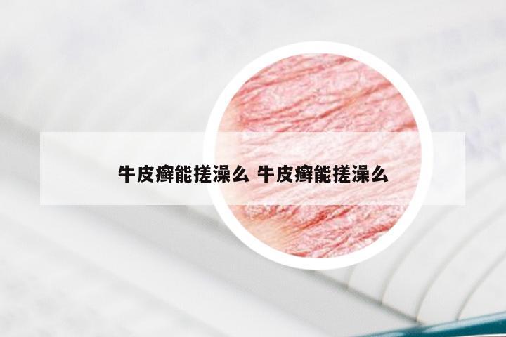 牛皮癣能搓澡么 牛皮癣能搓澡么