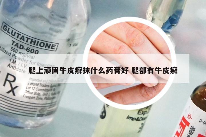 腿上顽固牛皮癣抹什么药膏好 腿部有牛皮癣