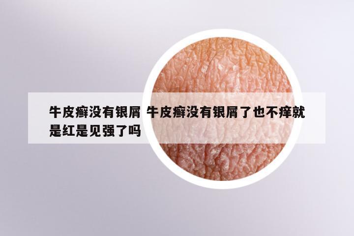 牛皮癣没有银屑 牛皮癣没有银屑了也不痒就是红是见强了吗