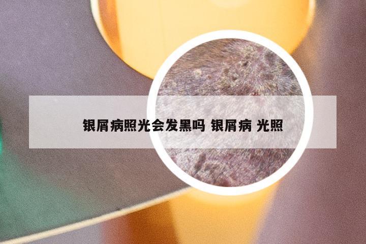 银屑病照光会发黑吗 银屑病 光照