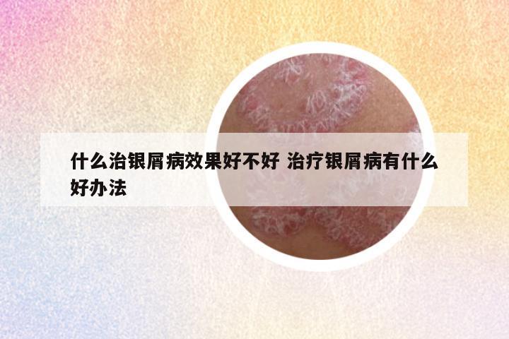 什么治银屑病效果好不好 治疗银屑病有什么好办法