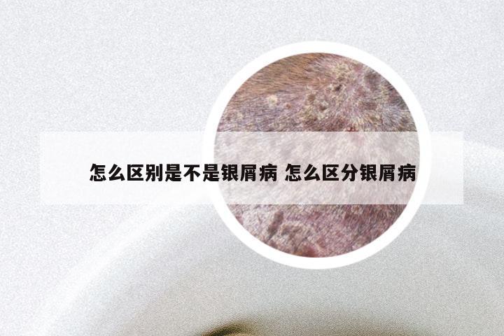 怎么区别是不是银屑病 怎么区分银屑病