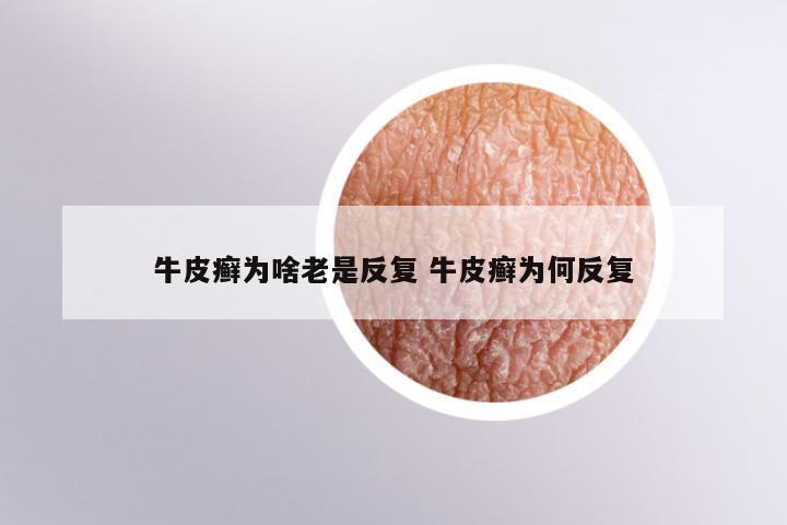 牛皮癣为啥老是反复 牛皮癣为何反复