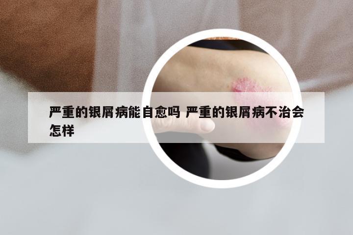 严重的银屑病能自愈吗 严重的银屑病不治会怎样