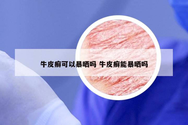 牛皮癣可以暴晒吗 牛皮癣能暴晒吗