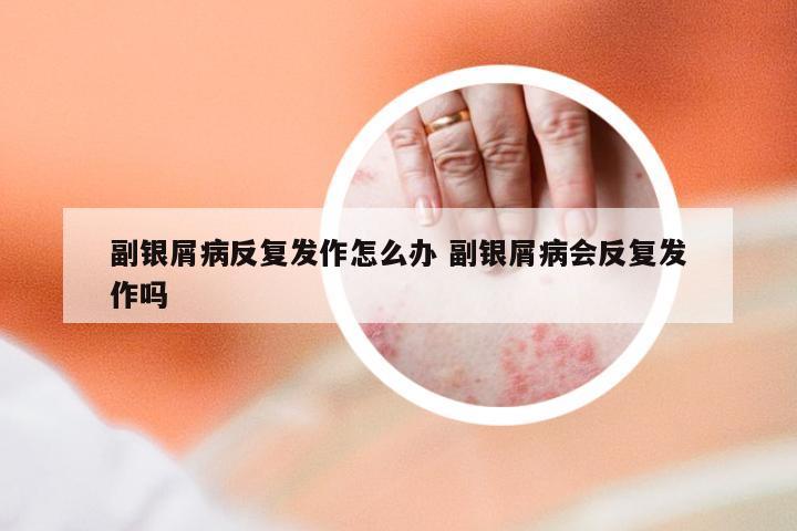 副银屑病反复发作怎么办 副银屑病会反复发作吗