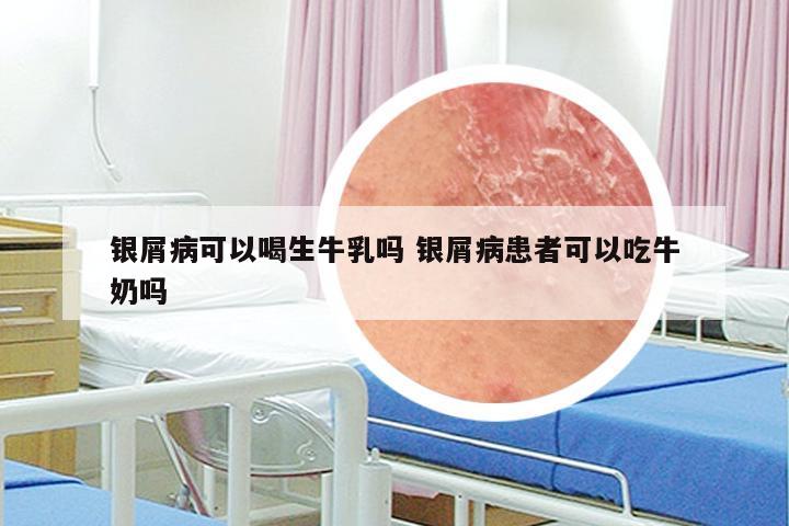 银屑病可以喝生牛乳吗 银屑病患者可以吃牛奶吗