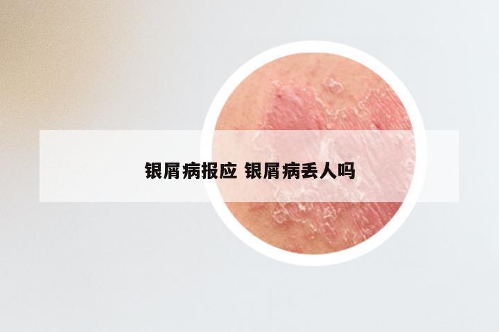 银屑病报应 银屑病丢人吗