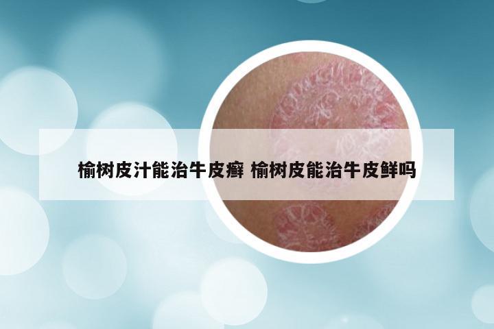 榆树皮汁能治牛皮癣 榆树皮能治牛皮鲜吗