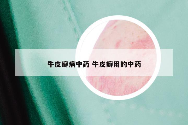 牛皮癣病中药 牛皮癣用的中药