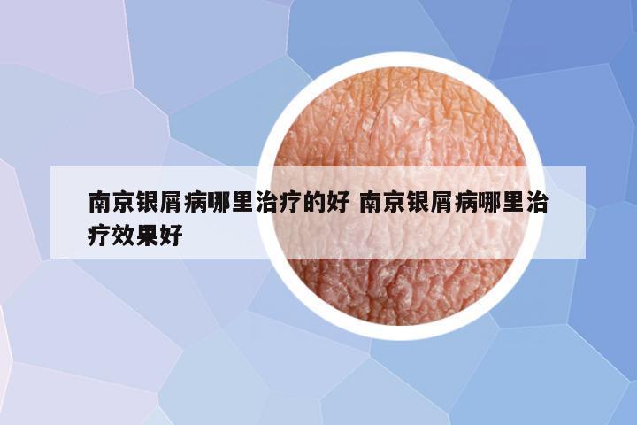 南京银屑病哪里治疗的好 南京银屑病哪里治疗效果好