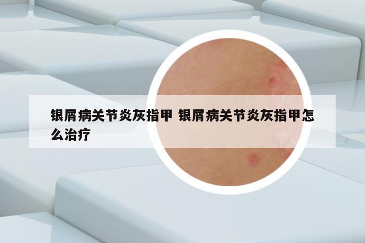 银屑病关节炎灰指甲 银屑病关节炎灰指甲怎么治疗