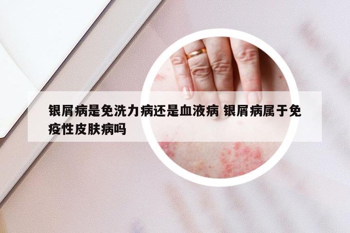 银屑病是免洗力病还是血液病 银屑病属于免疫性皮肤病吗