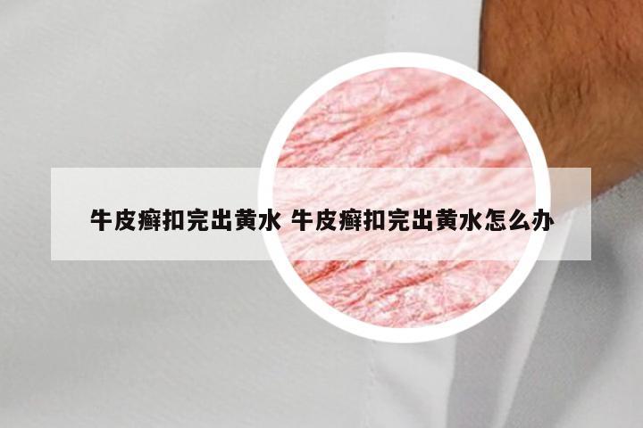 牛皮癣扣完出黄水 牛皮癣扣完出黄水怎么办