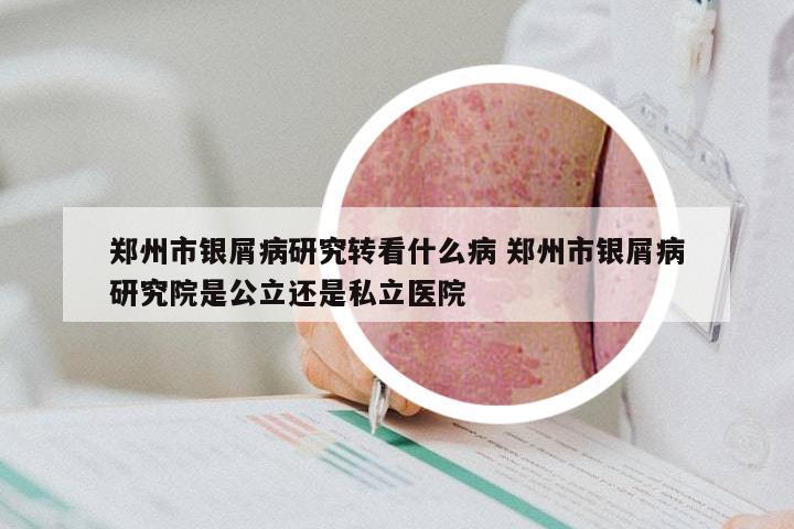 郑州市银屑病研究转看什么病 郑州市银屑病研究院是公立还是私立医院