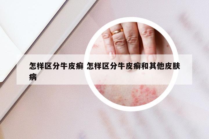 怎样区分牛皮癣 怎样区分牛皮癣和其他皮肤病