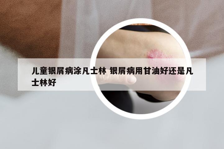 儿童银屑病涂凡士林 银屑病用甘油好还是凡士林好