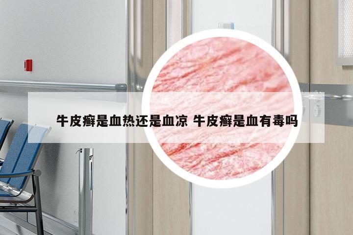 牛皮癣是血热还是血凉 牛皮癣是血有毒吗