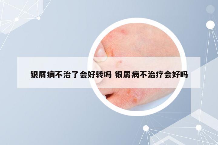 银屑病不治了会好转吗 银屑病不治疗会好吗
