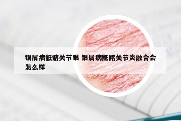 银屑病骶髂关节眼 银屑病骶髂关节炎融合会怎么样